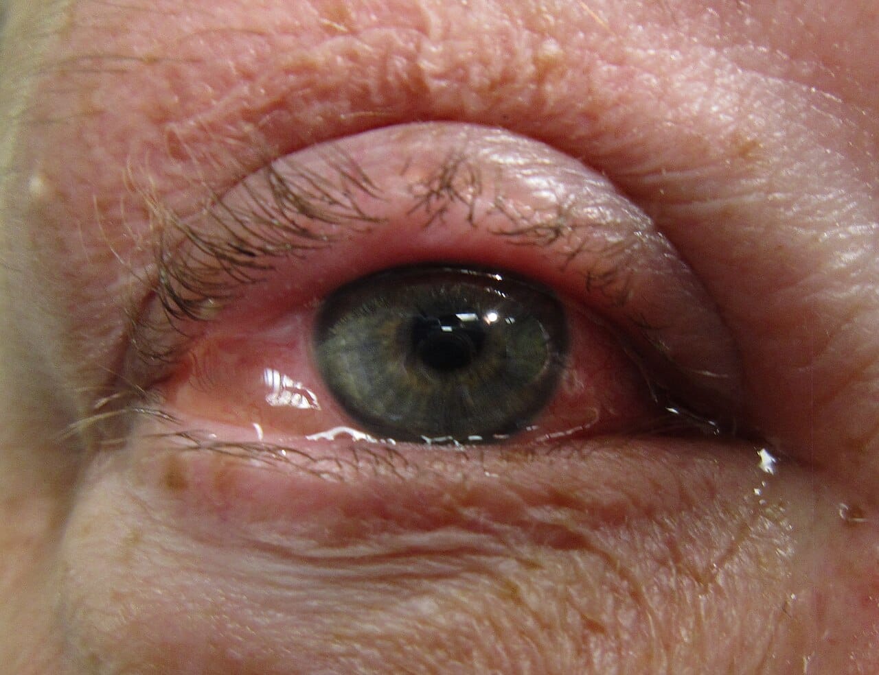 Allergic conjunctivitis. Airborne allergens produce symptoms wherever mucosal surfaces are exposed, which is why hay fever affects the eyes and nose together.