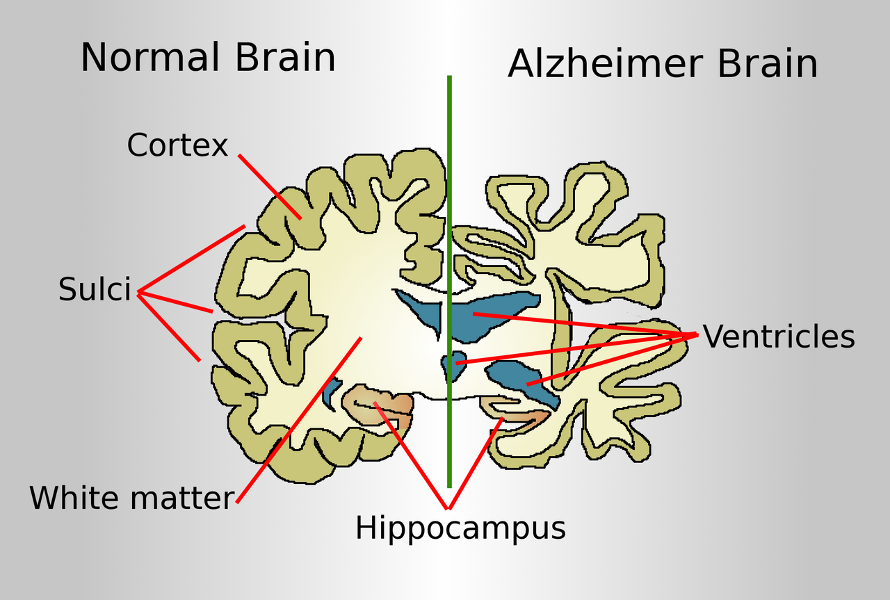 Alzheimer's brain atrophy. The correlation between plaque burden and cognitive impairment is weaker than the hypothesis predicts, and tau pathology tracks symptoms more closely.