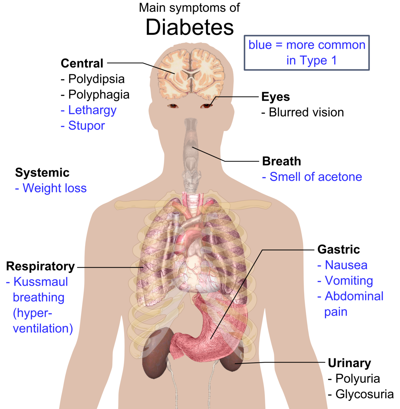 Type 1 diabetes results from immune destruction of the insulin-producing cells of the pancreas, one of the clearest examples of an organ-specific autoimmune disease.