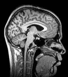 A magnetic resonance image. Strong magnetic fields and radio pulses distinguish soft tissue in fine detail without ionising radiation.