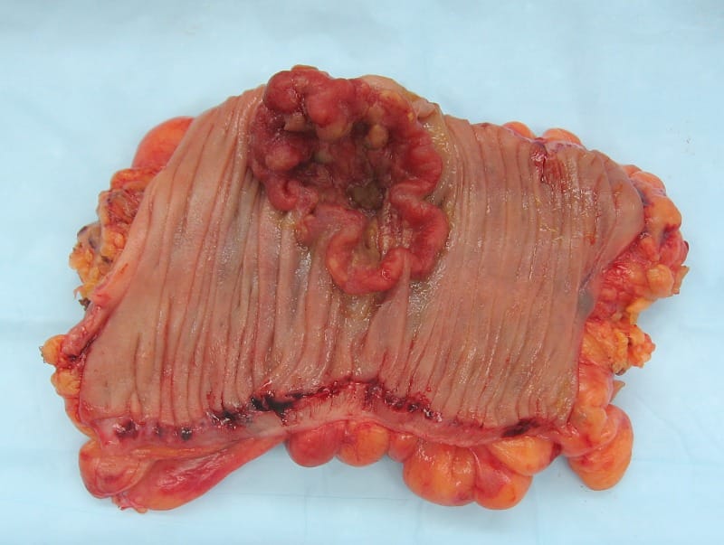 A colon tumour. The clinical pattern requiring explanation is a tumour that shrinks dramatically under treatment and returns later, more aggressive than before.
