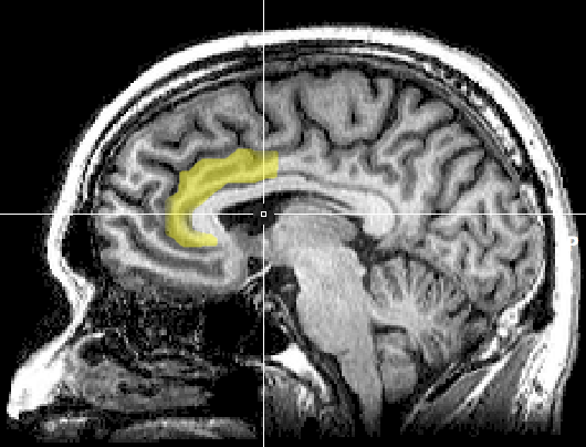 Brain imaging studies have found measurable neural signatures associated with cognitive dissonance.