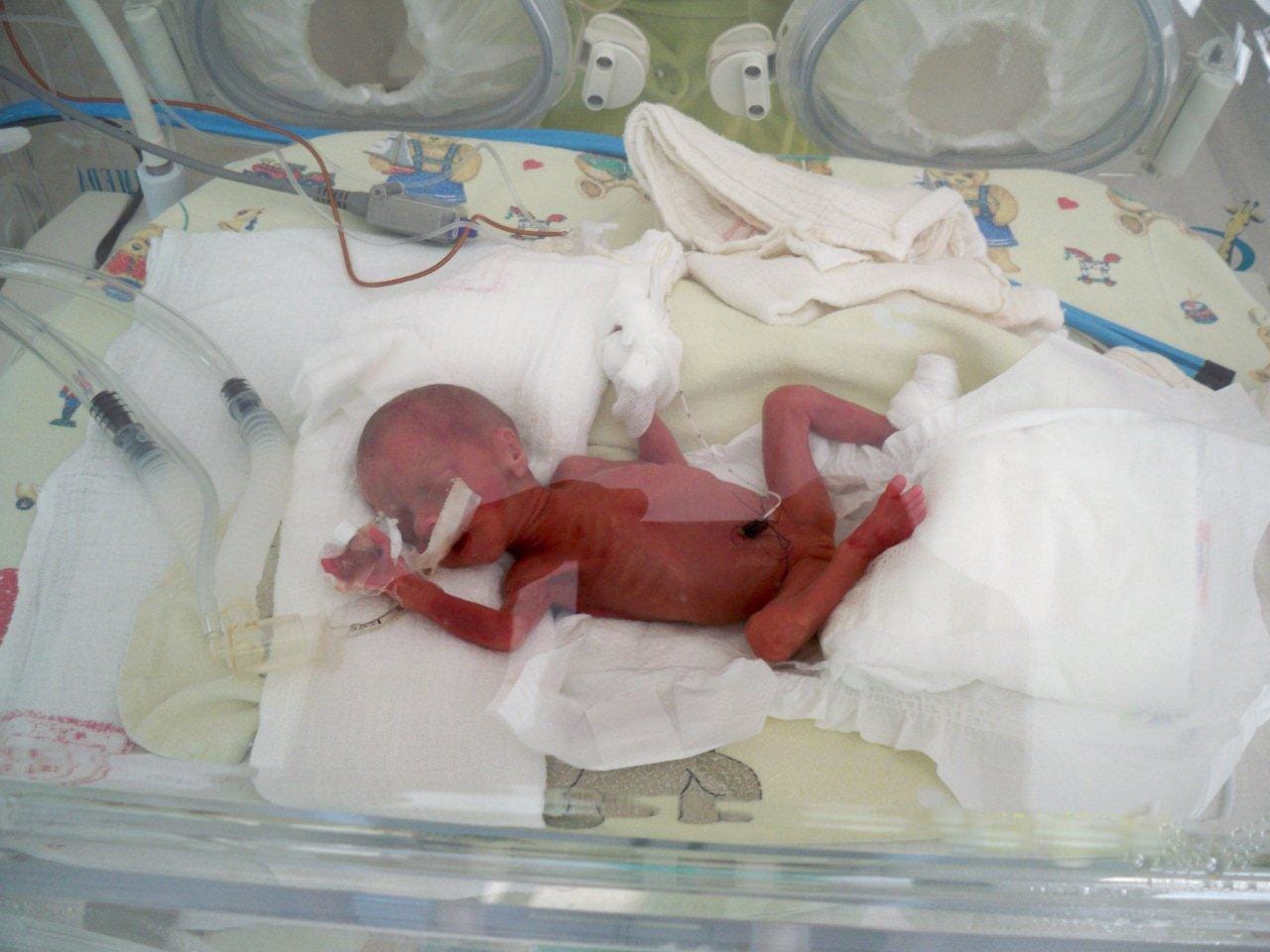 A low birth weight infant. The Hertfordshire records linked birth weight to cardiovascular mortality six decades later, which is the observation the field is built on.