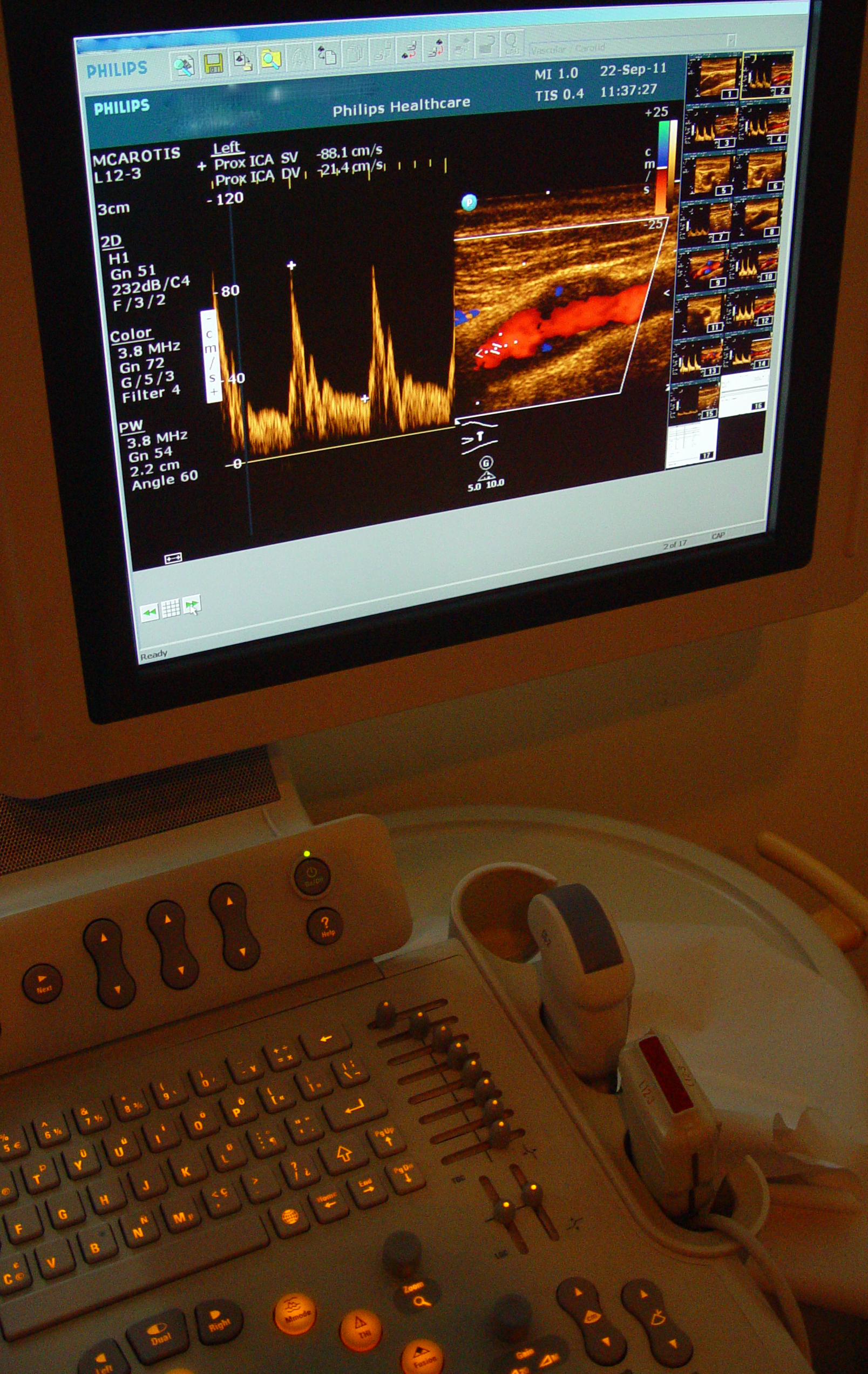 Colour Doppler ultrasound, which uses the effect to image blood flow in the body.