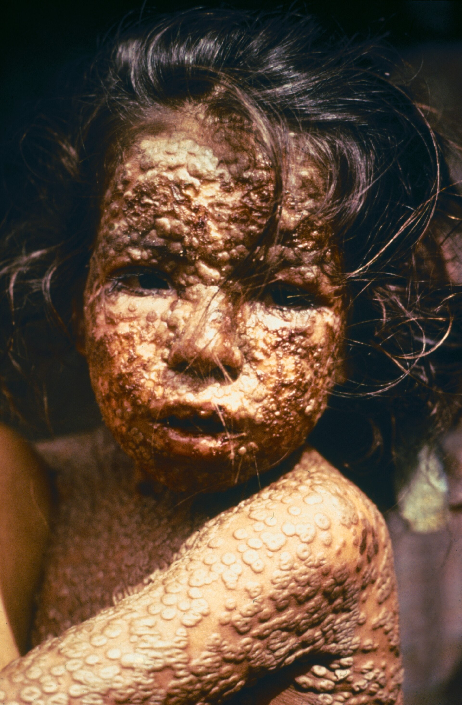 A child in Bangladesh during the era of the last cases, before the disease was finally cornered and eliminated.