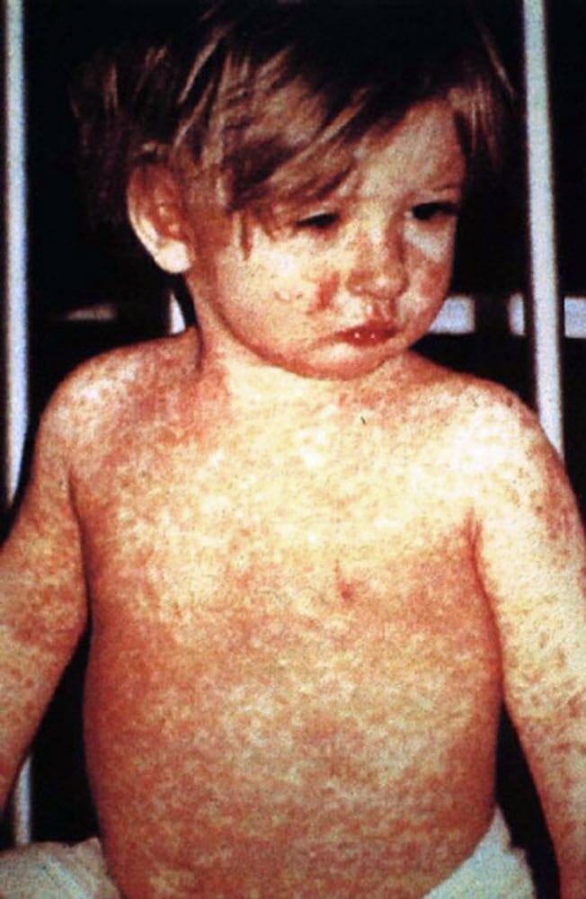 Measles. With a basic reproduction number among the highest known, it requires roughly 92 to 95 per cent immunity, which is why it is the first disease to return when coverage slips.