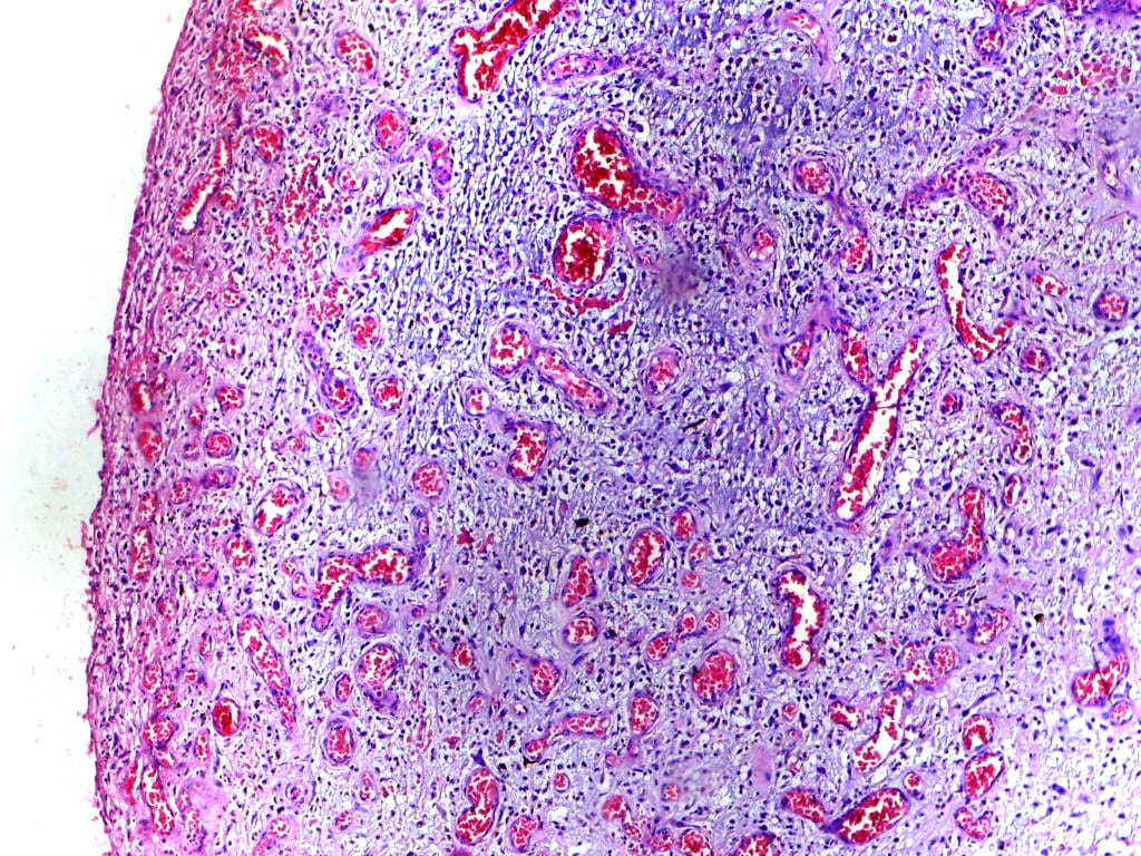 Granulation tissue forming during repair. Resolution is an active process rather than the absence of inflammation, and failure of resolution is what produces chronic disease.