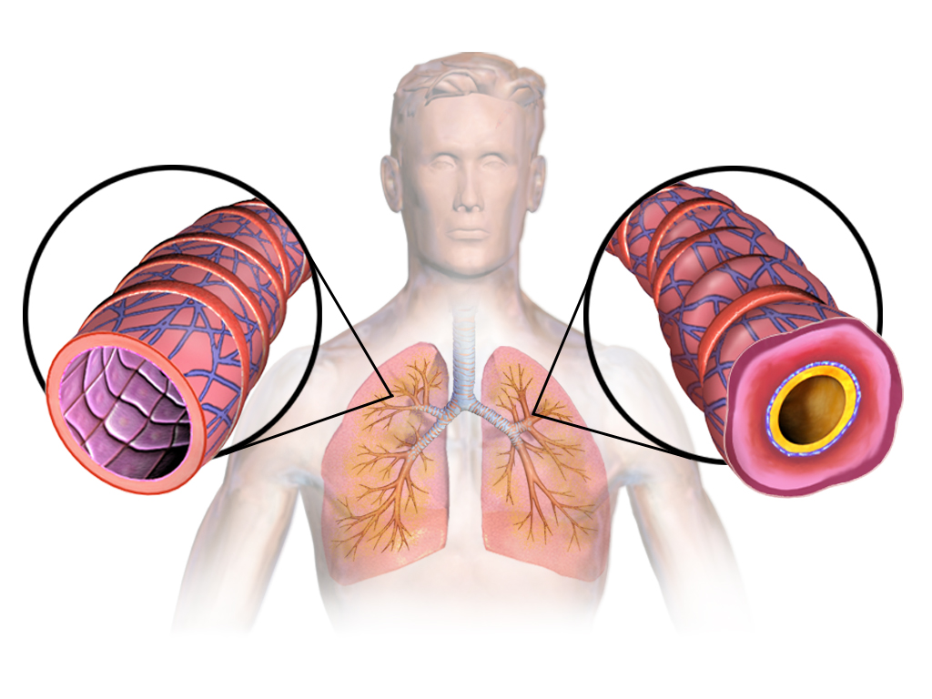 Airway inflammation in asthma. A response directed at something harmless produces the disease, which is why treatment is largely aimed at suppressing the response itself.