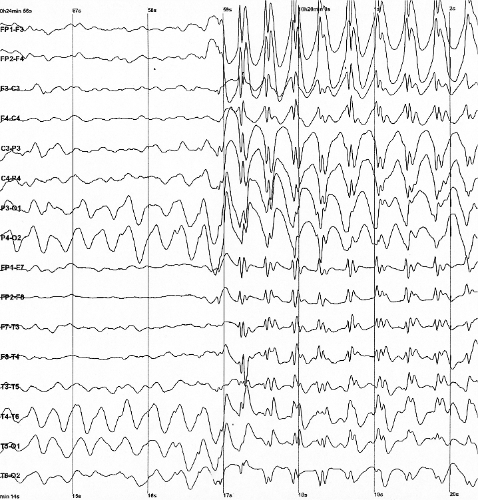 Electroencephalography. Measures of the complexity of cortical responses to perturbation, derived from the theory, distinguish conscious from unconscious states reliably.