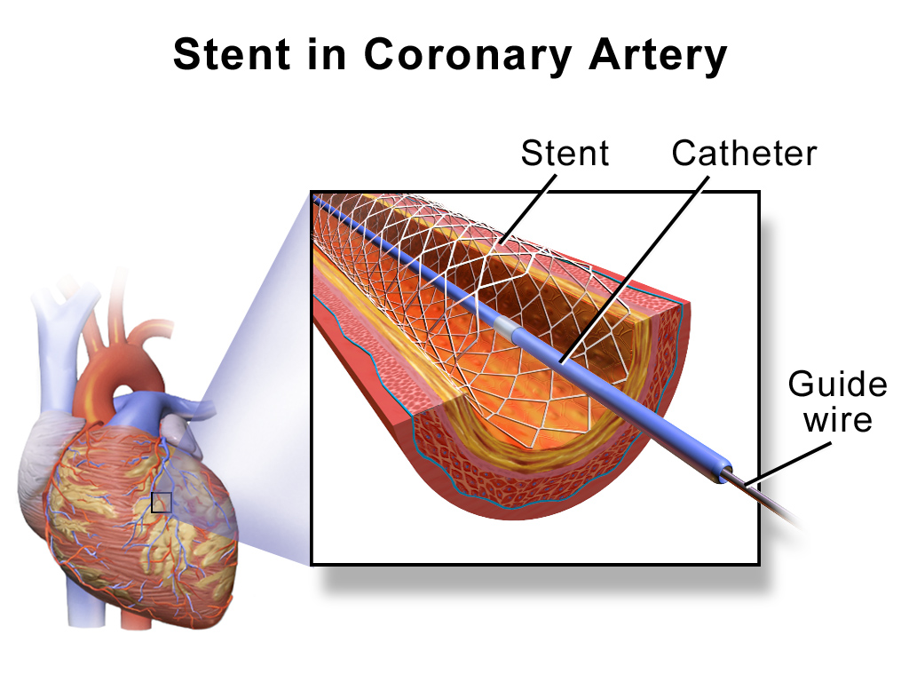 A self-expanding stent. Compressed into a catheter and released at the target site, it expands to its remembered shape at body temperature, which is the single largest application of these alloys.