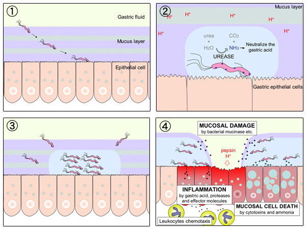 The route from infection to ulceration. The bacterium colonises the mucus layer, provokes chronic inflammation, and the lining is breached where the inflammation is most severe.