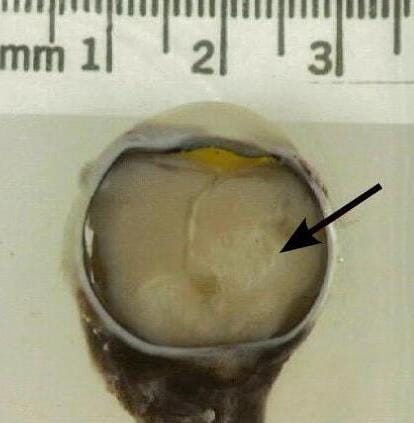 Retinoblastoma in a removed eye. Its two distinct patterns of occurrence, hereditary and sporadic, are what Knudson analysed.