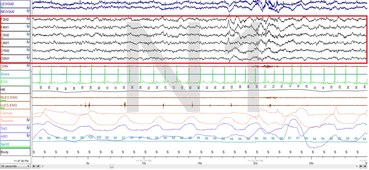 An electroencephalogram trace from light sleep. The stages of sleep are defined by these signatures, and their orderly progression through the night is one of the most reliable phenomena in physiology.